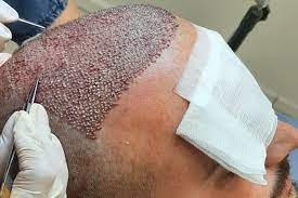 Factors Influencing the Cost of a Hair Transplant: Understanding Treatment Expenses